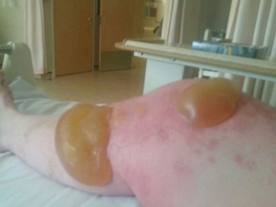 2_giant-hogweed-burns.jpg
